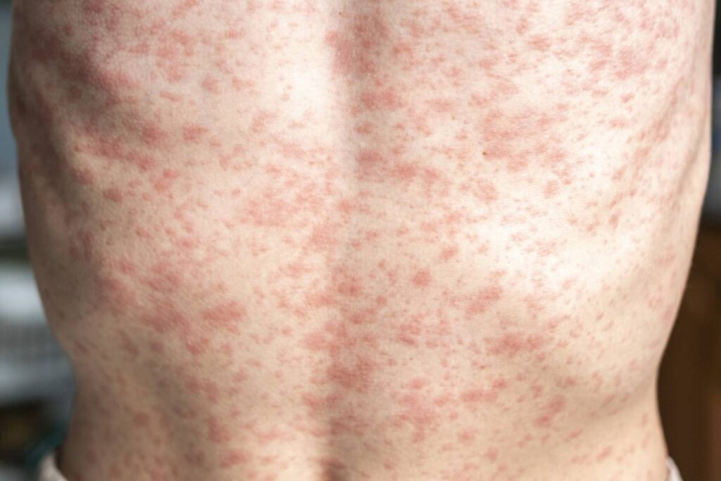 Rougeurs et inconfort cutané : mieux comprendre pour mieux apaiser
