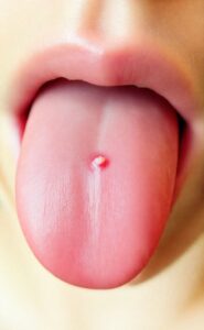 Bouton sur la langue : causes, symptômes et traitements