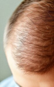 Calvitie traitement : solutions pour retrouver vos cheveux