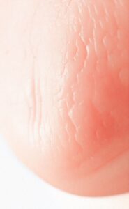 Muqueuse subatrophique : explications claires